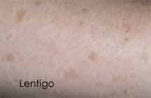Image result for liver spots on legs