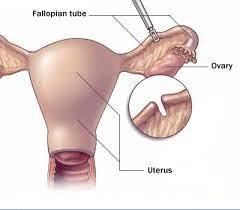 Tubal Ligation Reversal Is Surgery To Reopen Untie Or Reconnect A Woman S Fallopian Tubes So Healthcare Marketing Fallopian Tubes Obstetrics And Gynaecology