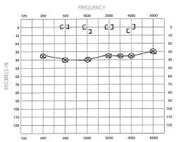 Audiograms Aussie Deaf Kids