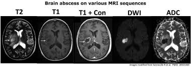 Image result for Brain Abscess
