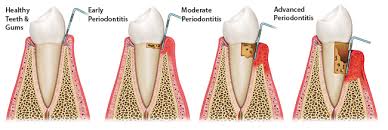 Periodontal Disease Progression Federal Way Dental Excellence