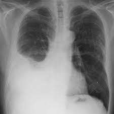 All these findings indicate that we are dealing asbestos related pleural plaques. Multimodality Imaging For Characterization Classification And Staging Of Malignant Pleural Mesothelioma Radiographics