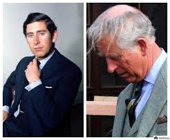 Prince Harry Hair Transplant | A Royal ...