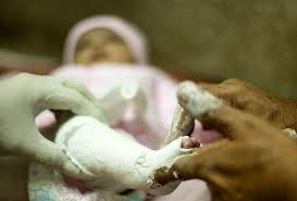 The ponseti method of clubfoot treatment is minimally invasive and 96% effective. Behandlung Fur Klumpfuss Treatment Method Medical Information