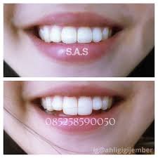 Bunny Smile Gigi Kelinci Kesehatan Gigi Trik Makeup Kedokteran Gigi