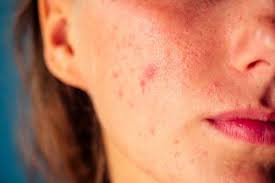 Image result for acne face
