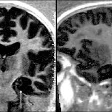 Mayo 20, 2012 guías de práctica clínica, neurología no comments. Esclerosis Temporal Mesial Y Hemiatrofia Cerebral Izquierdas Caso 9 Download Scientific Diagram