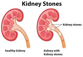 What You Need To Know About Diabetes Gallstones And Kidney