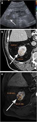 Adenocarcinoma is the most common type of renal malignancy (referred to as rcc) occurring less commonly in the bladder and ureter. Active Surveillance Of Small Renal Masses Insights Into Imaging Full Text