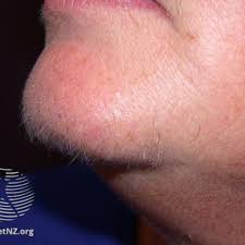 Beard growth is fueled by male hormones, lower levels may cause beard loss. Treating Hirsutism In Women With Pcos