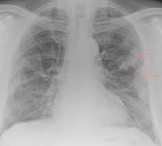 Chest radiography remains the initial modality for the detection and characterization of pleural and parenchymal disease. Epos