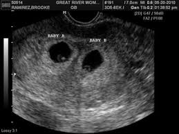 The exact time twins can be detected depends on the type of twins, for example, if they're identical (from one egg) or not. 24 Ultraschallbild Ideen Ultraschallbild Ultraschall Baby Kinderzimmer Ideen
