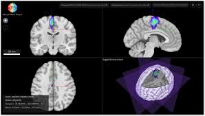 We did not find results for: Probabilistic Cytoarchitectonic Maps For 32 New Human Brain Areas Released News