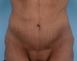 Breast augmentation, tummy tuck, face lift and many more other procedures. Fleur De Lys Abdominoplasty The Cosmetic Surgery Clinic