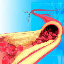 Image result for Blood Transfusion