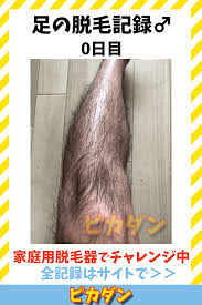 足脱毛の記録0日目 毛深い30代男が家庭用脱毛器で挑戦中 脱毛 脱毛器 目