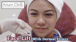 Filler Injection With Natural Results Singapore