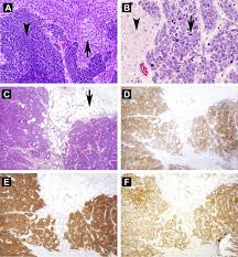 The color of hair dye. Small Cell Bladder Cancer Response To Second Line And Beyond Checkpoint Inhibitor Therapy Retrospective Experience Clinical Genitourinary Cancer