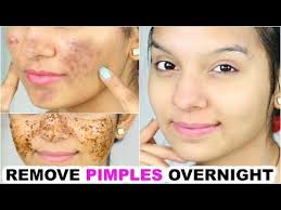 Remove Pimples Overnight 100 Success How To Remove Pimples Remove Pimples Overnight Acne Scar Removal