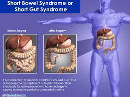 Short Bowel Syndrome Or Short Gut Syndrome Treatment Causes Symptoms