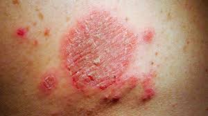 Image result for allergy rash on the legs