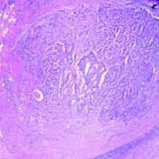 Carcinoid tumor is a rare type of tumor that usually grows slowly. Tejido Tiroideo Con Foliculos Y Foco De Tumor Carcinoide Trabecular Download Scientific Diagram