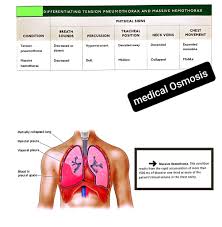 Image result for Hemothorax