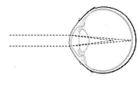 The way i determine it is just by comparing my eyes to different peoples' pictures. About Your Vision Stanford Eye Laser Center Stanford Medicine