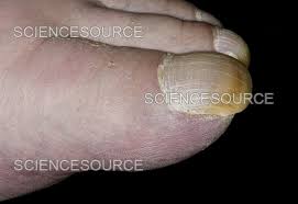 Image result for Clubbing nails feet