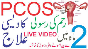 Endometriosis is defined as the presence of normal endometrial mucosa (glands and stroma) abnormally implanted in locations other than the uterine cavity (see the image below). Pcos Ka Ilaj In Urdu Pcs Ka Ilaoj Pcos Ka Desi Ilaj By Shakeel Abbasi Reham