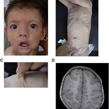 Sanger sequencing chromatograms showing mutations. A. Patient 1 showing... 
