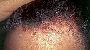 Image result for sores on the head in children