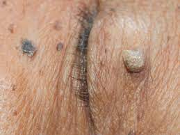 Of the skin tag, against my armpit. When To Consider Skin Tag Removal Orlando Fl Dr Jeannette Hudgens