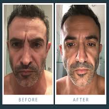 Forehead wrinkles can dramatically age your appearance, but thankfully, there are things you can do to reduce the appearance of these wrinkles and even get rid of them completely. Amazon Com Wrinkles Schminkles Men S Forehead Silicone Pads Made In Usa 100 Medical Grade Reusable Silicone Wrinkle Patches For Smoothing Frown Lines Face Lift Wrinkle Remover For Men Premium Beauty
