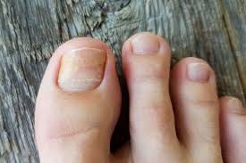 Image result for Beau lines feet