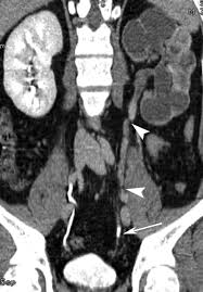Image result for Genitourinary Tuberculosis