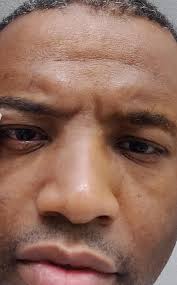 Anyone wondering what's wrong with Patrick's eye ,doesn't look right tonight