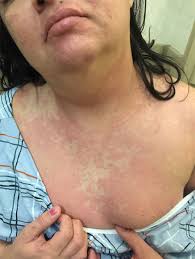 The virus has resurged in europe and the united states in the fall of 2020. Covid 19 Skin Rashes Perlis Clifford Keydermpartners Com