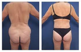 Die spiele, ergebnisse und liveticker des aktuellen spieltags in der bbl im basketball: Buttock Augmentation Requires Lateral Hip Filling Dr Arian Mowlavi