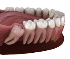 In fact, most extractions take just a few minutes. Remove Wisdom Teeth Frisco Tx Oral Surgery Impacted Molars Highland Oak Dental