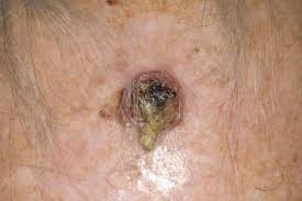 Actinic keratosis (solar keratosis) these small, scaly patches are caused by too much sun, and commonly occur on the head, neck, or hands. Skin Cancer Clinical Advisor