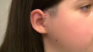 Rare tumour sees Queensland teen's jaw reconstructed using her ribs