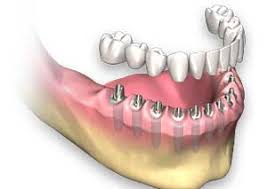Chin implants and metal detectors. Dental Implants Procedure Pain Cost Benefits And Risk Sanjivani Dental Clinic