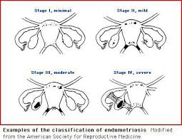 The 4 Stages Of Endometriosis Endometriosis Stages