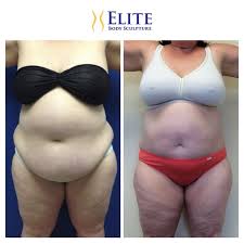 Pin On Airsculpt Before After Elite Body Sculpture