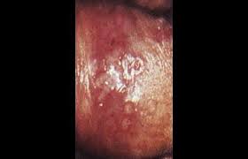 Image result for genital herpes