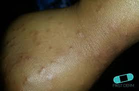 Image result for scabies human bites