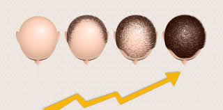 #thesalonguy #hairtutorial #hairtipshow long does it take for hair to grow? Hair Transplant How Fast Does Hair Grow After With Pictures
