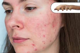 Image result for demodex rosacea