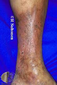 Image result for Lipodermatosclerosis